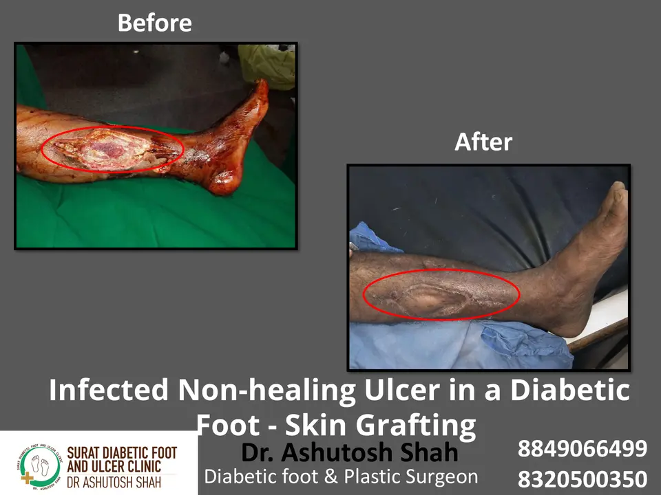 Diabetic Foot  PPT 3 checked by sir.pptx-11.webp